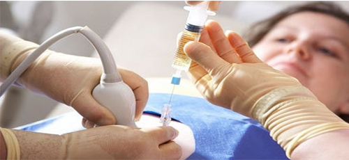 تشخیص پیش از تولد با نمونه پرز جنین (CVS)