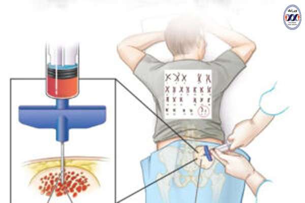 آزمایش کاریوتیپ مغز استخوان
